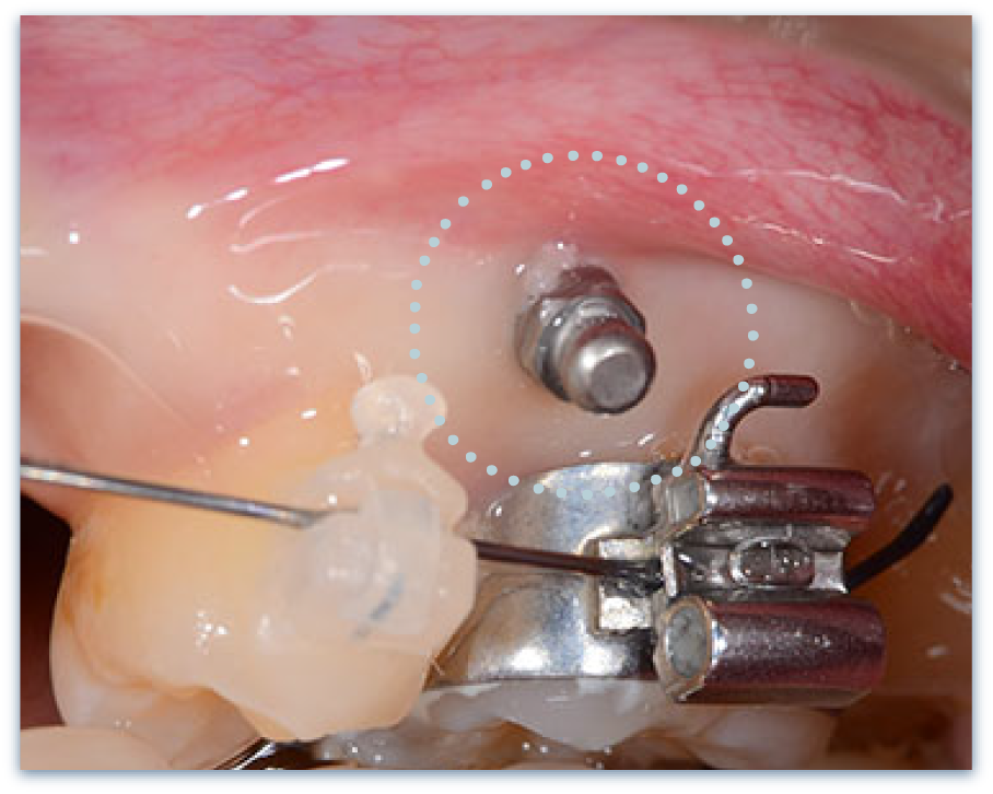 アンカースクリュー