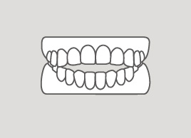 オープンバイト